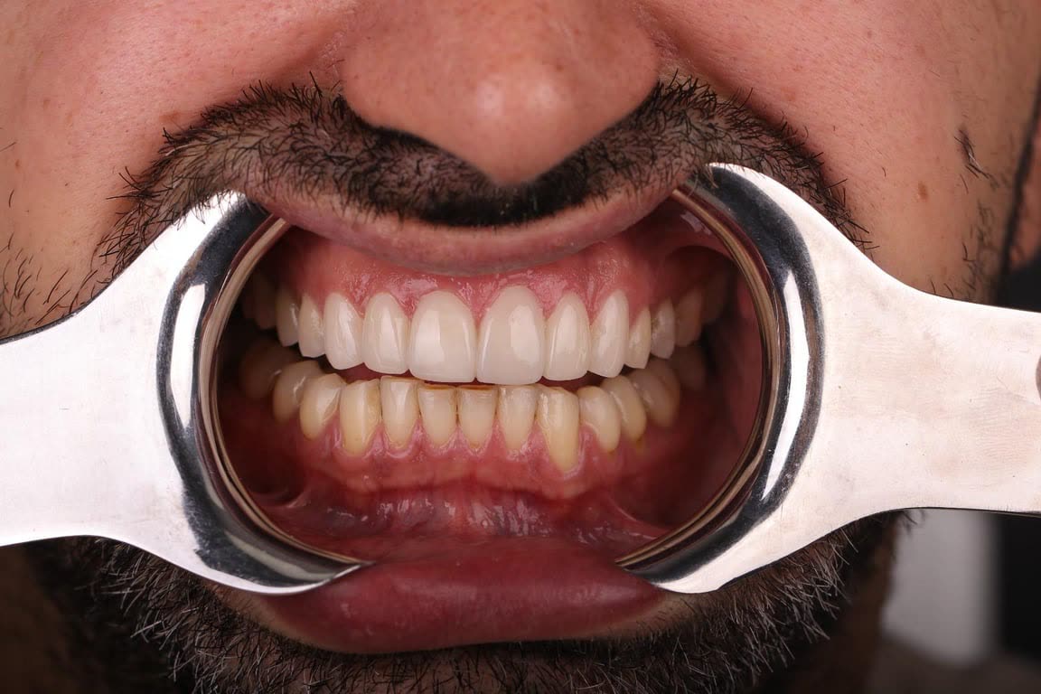 שיניים אחרי ציפוי — חיוך אחיד ובהיר